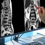 Degeneración discal lumbar en resonancia magnética